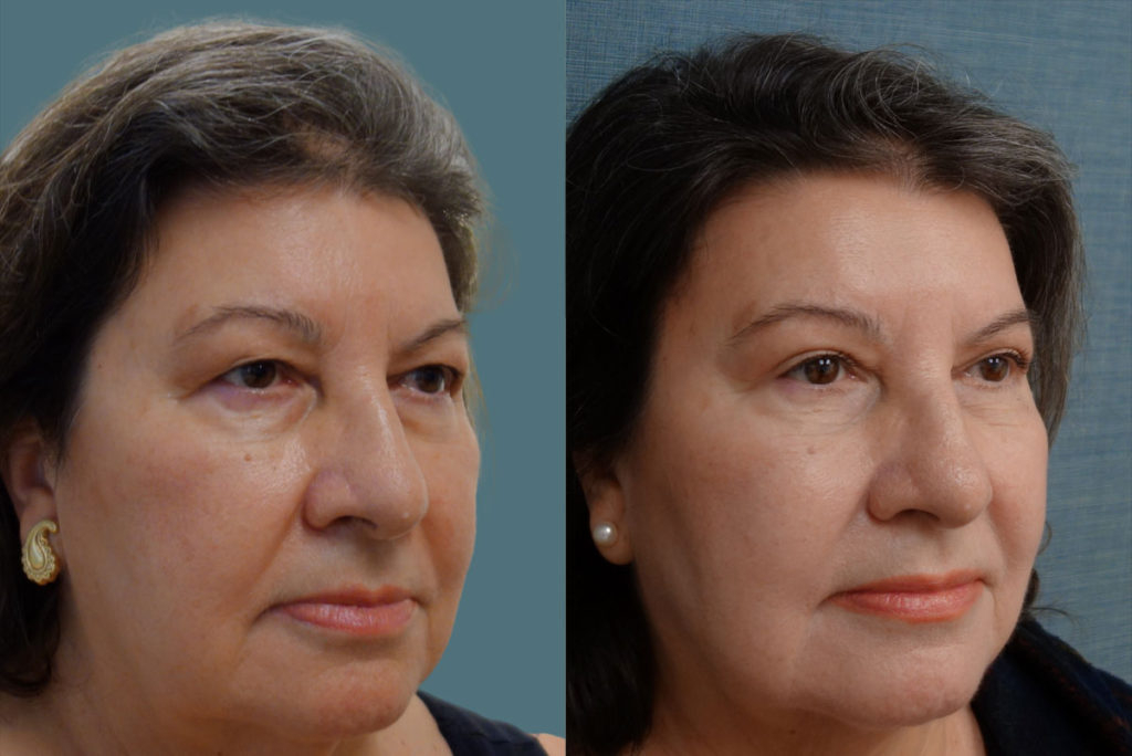 Upper Eyelid Blepharoplasty, Mini Brow Lift Patient 06-B 