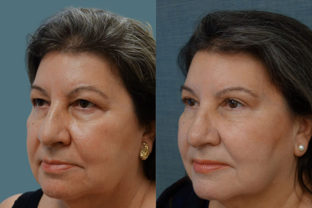 Upper Eyelid Blepharoplasty, Mini Brow Lift Patient 06-C 