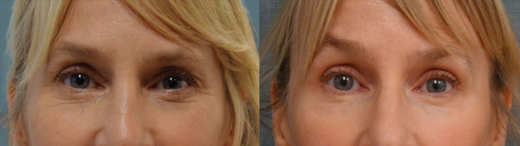 Upper Eyelid Blepharoplasty, Left Mini Brow Lift Patient 09-A 