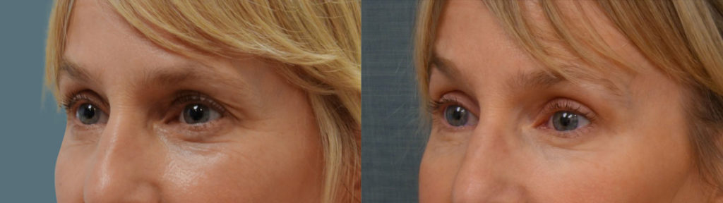 Upper Eyelid Blepharoplasty, Left Mini Brow Lift Patient 09-B 