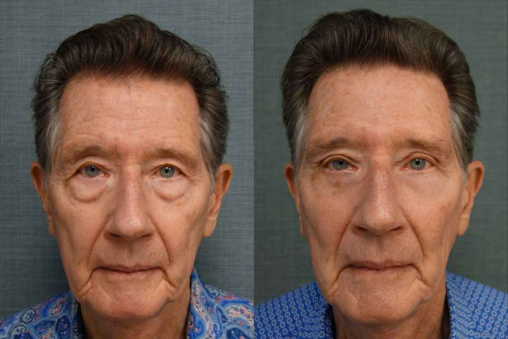 Upper Eyelid Blepharoplasty, Direct Brow Lift, Lower Eyelid Blepharoplasty, Right Lower Eyelid Entropion Repair, Chemical Peel to Lower Eyelids Patient 24-A 
