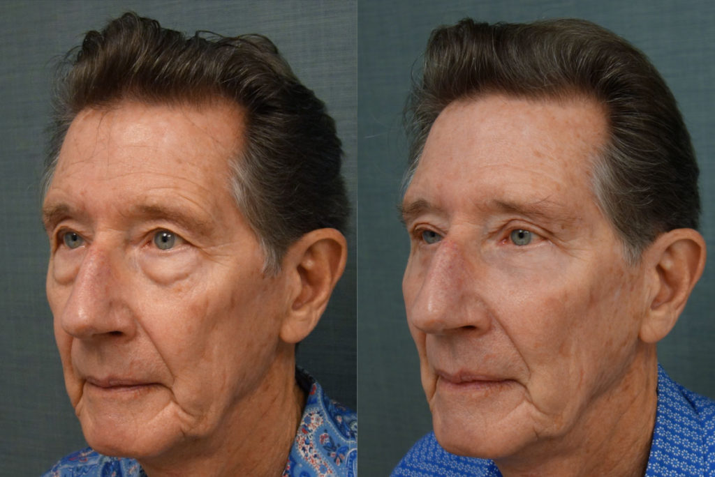 Upper Eyelid Blepharoplasty, Direct Brow Lift, Lower Eyelid Blepharoplasty, Right Lower Eyelid Entropion Repair, Chemical Peel to Lower Eyelids Patient 24-C 