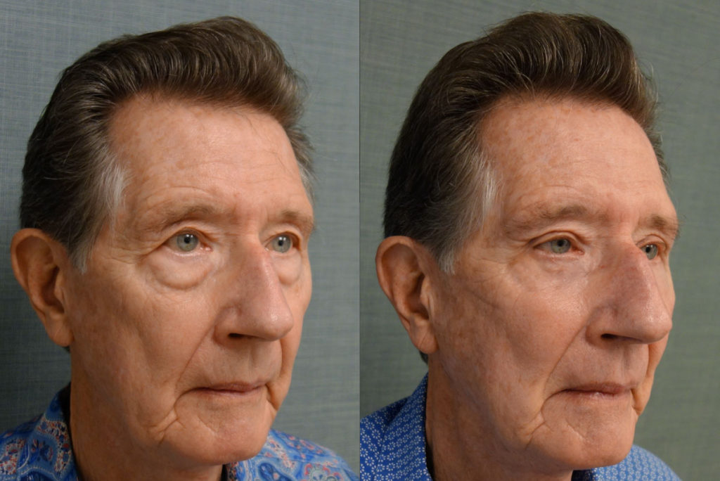 Upper Eyelid Blepharoplasty, Direct Brow Lift, Lower Eyelid Blepharoplasty, Right Lower Eyelid Entropion Repair, Chemical Peel to Lower Eyelids Patient 24-B 