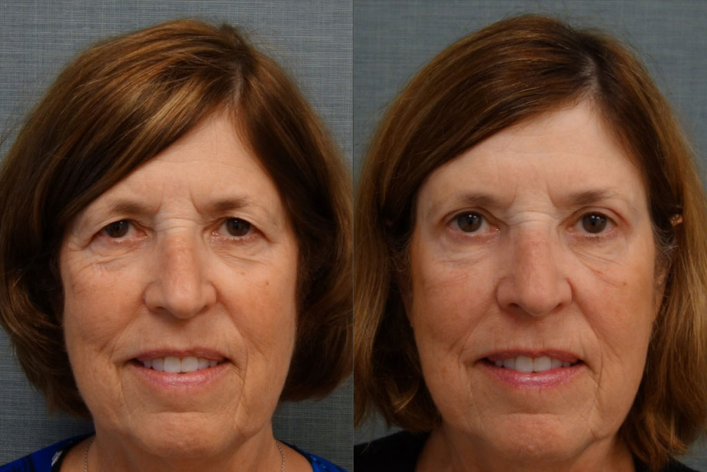 Upper Eyelid Blepharoplasty, Mini Brow Lift Patient 10-A 