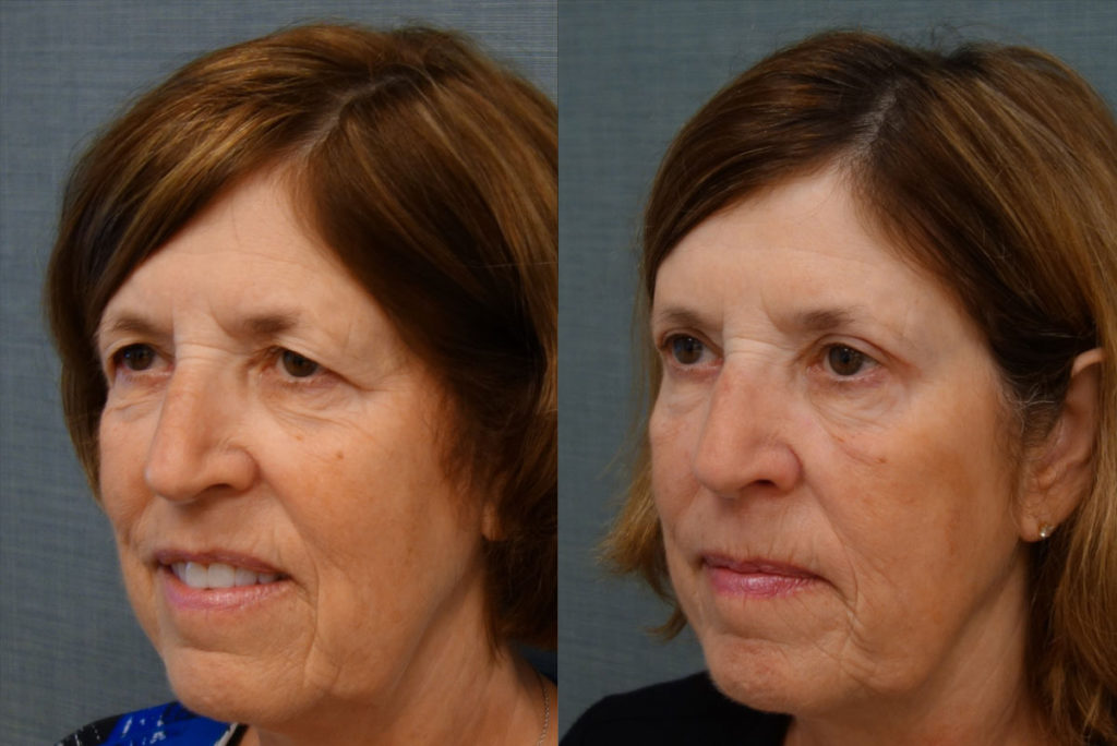 Upper Eyelid Blepharoplasty, Mini Brow Lift Patient 10-C 