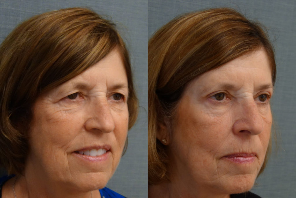 Upper Eyelid Blepharoplasty, Mini Brow Lift Patient 10-B 