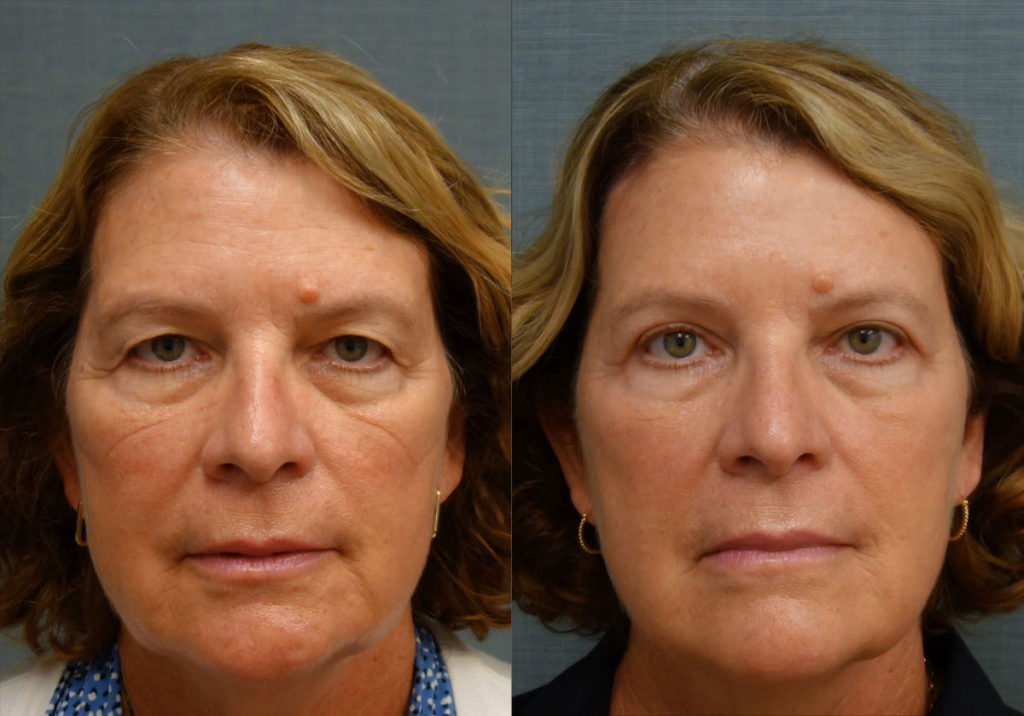 Upper Eyelid Blepharoplasty, Mini Brow Lift Patient 11-A 