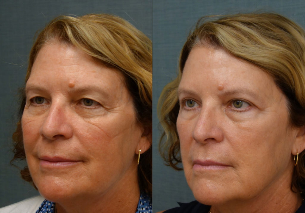 Upper Eyelid Blepharoplasty, Mini Brow Lift Patient 11-C 