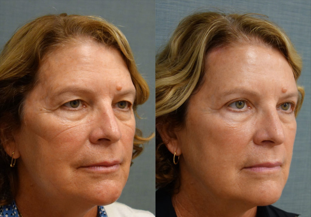 Upper Eyelid Blepharoplasty, Mini Brow Lift Patient 11-B 