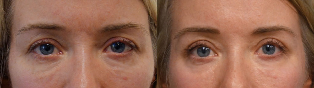 Upper Eyelid Blepharoplasty, Mini Brow Lift, Chemical Peel to Lower Eyelids Patient 12-A 