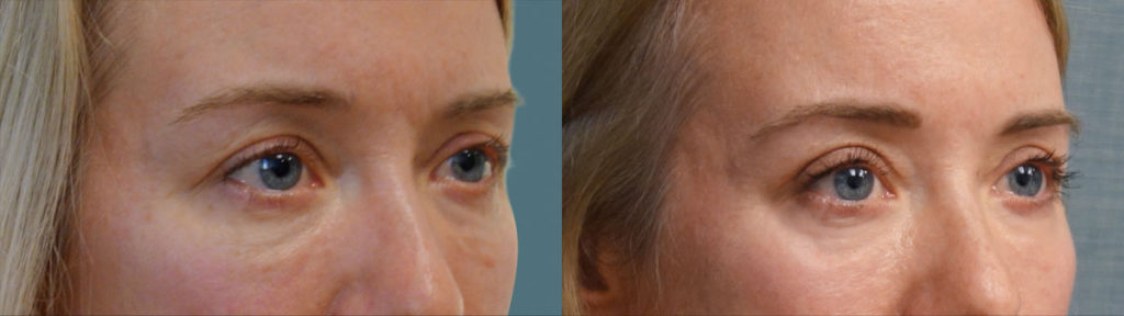Upper Eyelid Blepharoplasty, Mini Brow Lift, Chemical Peel to Lower Eyelids Patient 12-B 