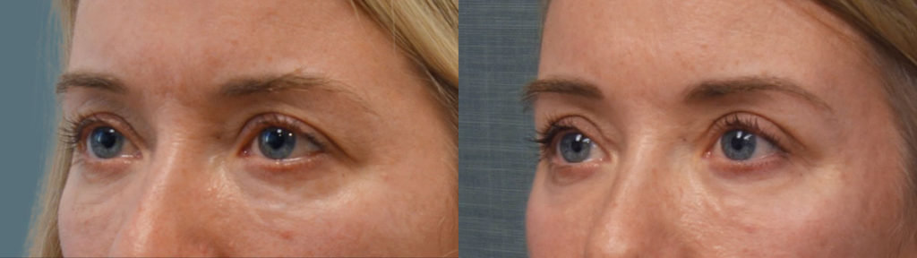 Upper Eyelid Blepharoplasty, Mini Brow Lift, Chemical Peel to Lower Eyelids Patient 12-C 