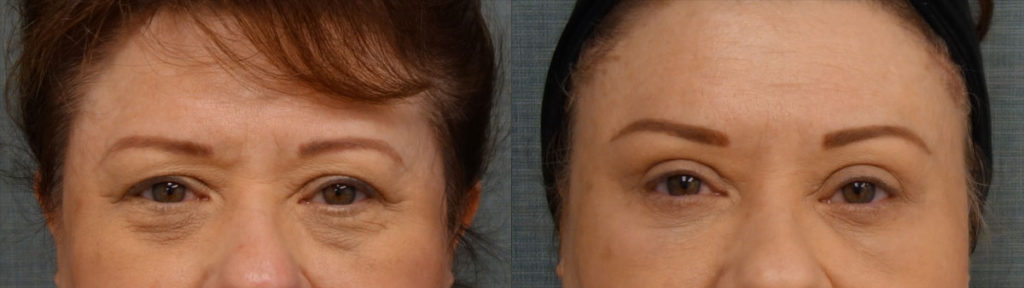 Upper Eyelid Blepharoplasty, Mini Brow Lift, Lower Eyelid Blepharoplasty with Internal Cheek Elevation, Chemical Peel to Lower Eyelids Patient 13-A 