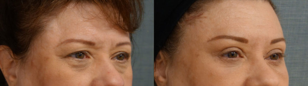 Upper Eyelid Blepharoplasty, Mini Brow Lift, Lower Eyelid Blepharoplasty with Internal Cheek Elevation, Chemical Peel to Lower Eyelids Patient 13-B 