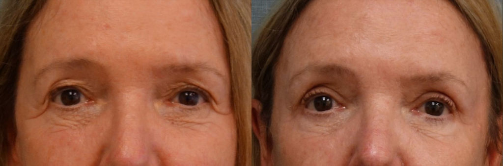 Upper Eyelid Blepharoplasty, Mini Brow Lift Patient 14-A 