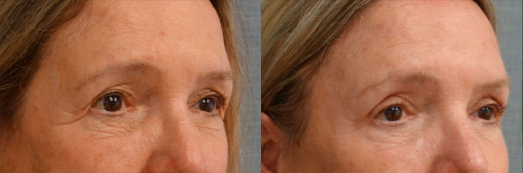 Upper Eyelid Blepharoplasty, Mini Brow Lift Patient 14-B 