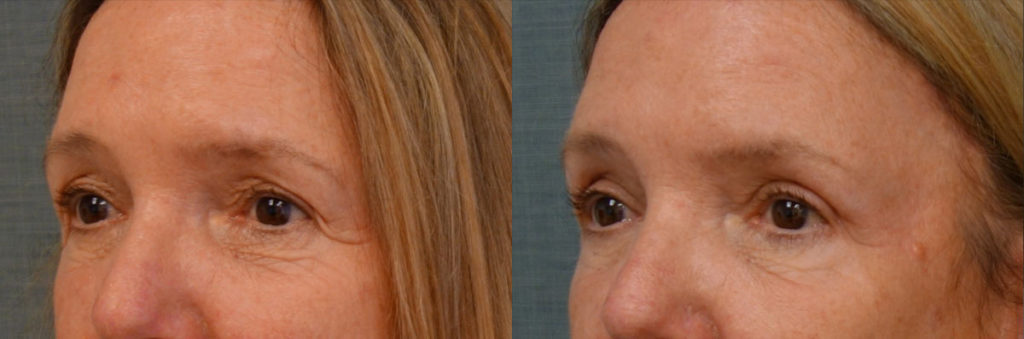 Upper Eyelid Blepharoplasty, Mini Brow Lift Patient 14-C 