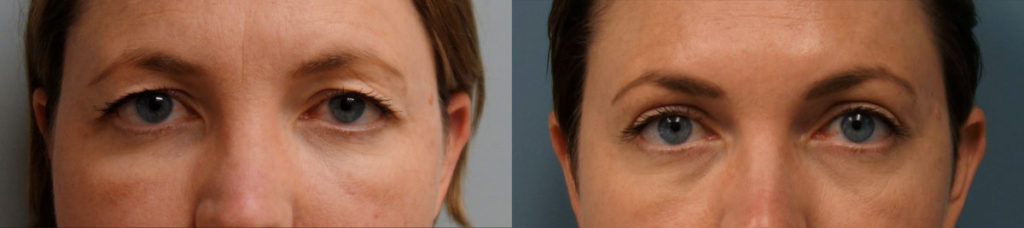 Bilateral Upper Eyelid Blepharoplasty, Left Upper Eyelid Ptosis Repair and Mini Brow Lift Patient 05-C 