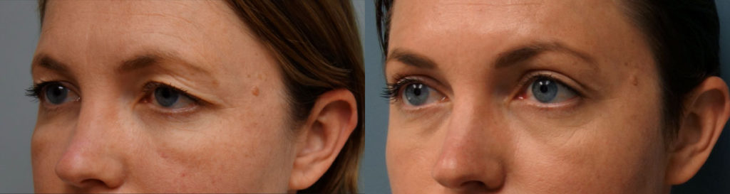 Bilateral Upper Eyelid Blepharoplasty, Left Upper Eyelid Ptosis Repair and Mini Brow Lift Patient 05-B 