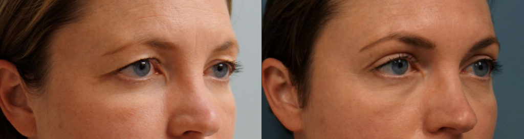 Bilateral Upper Eyelid Blepharoplasty, Left Upper Eyelid Ptosis Repair and Mini Brow Lift Patient 05-A 