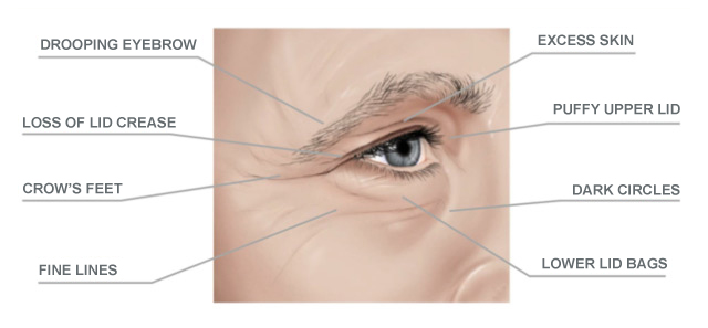 Aging Eyelids Newport Beach | Changing Eye Features Orange County