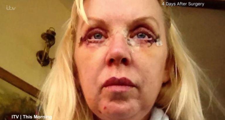 Women's botched surgery, scars around eyes