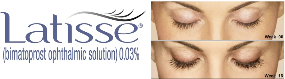 Latisse logo bimatoprost ophthalmic solution 0.03% before and after patient image