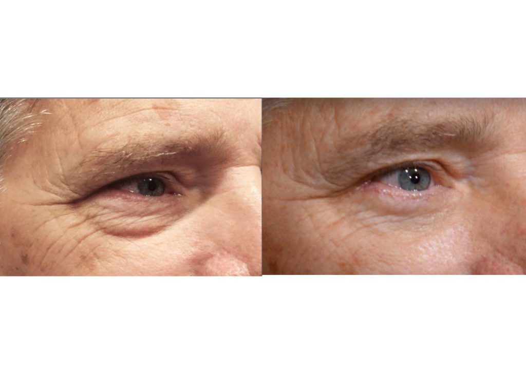 Lower Eyelid Blepharoplasty with Internal Cheek Elevation Patient 14-B 