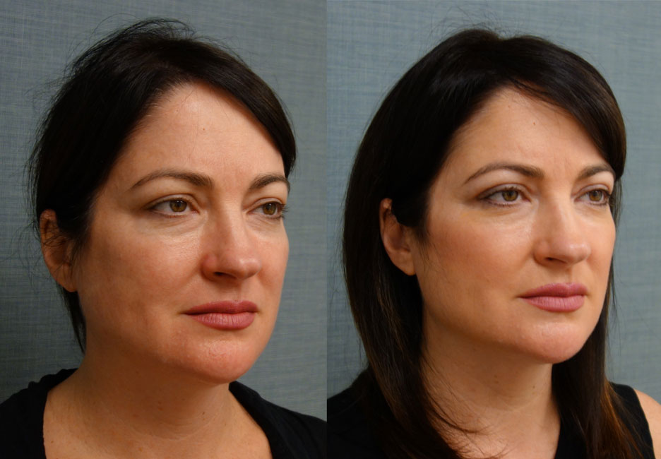 Upper Eyelid Blepharoplasty, FaceTite with Micro-Liposuction and Morpheus8 Microneedling to Lower Face Patient 08-A 