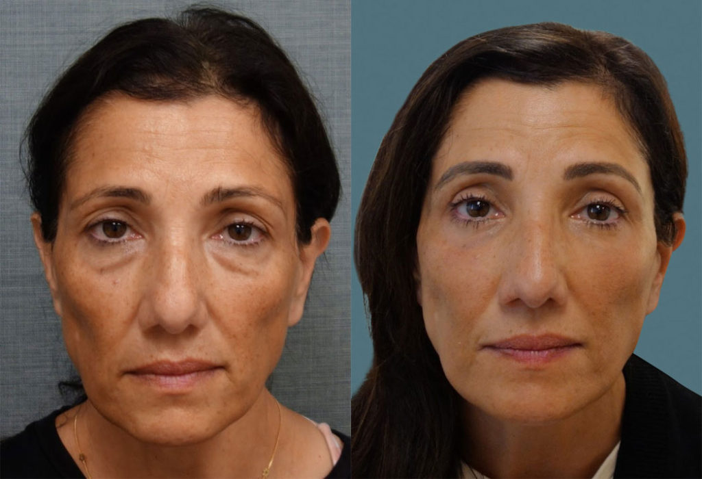 Upper & Lower Eyelid Blepharoplasty, Morpheus8 Microneedling to Full Face, Co2 Laser to Lower Eyelids Patient 07 