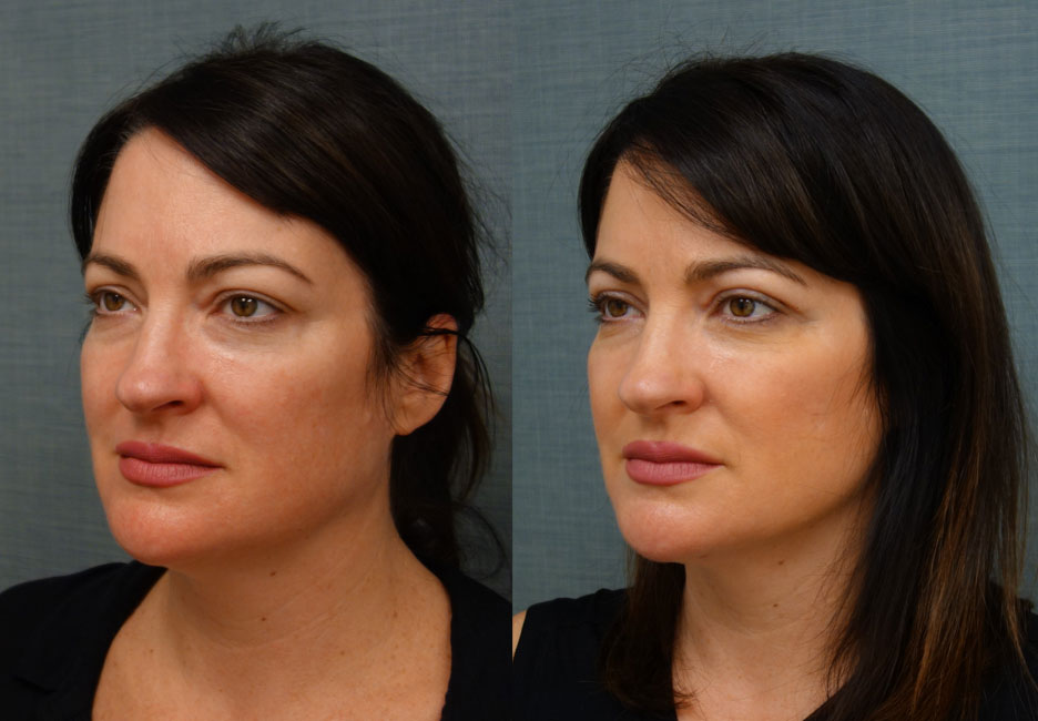Upper Eyelid Blepharoplasty, FaceTite with Micro-Liposuction and Morpheus8 Microneedling to Lower Face Patient 08-B 