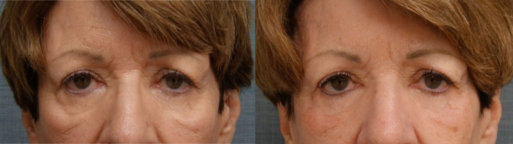 Co2 Laser & Morpheus8 Microneedling to Lower Eyelids & Cheeks Patient 09-A 