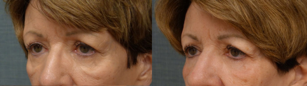 Co2 Laser & Morpheus8 Microneedling to Lower Eyelids & Cheeks Patient 09-C 