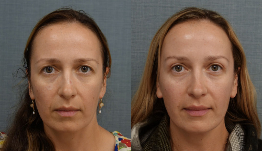 Bilateral Upper Eyelid Blepharoplasty Patient 11-A 