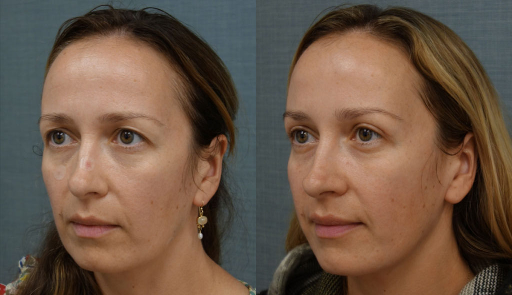 Bilateral Upper Eyelid Blepharoplasty Patient 11-C 