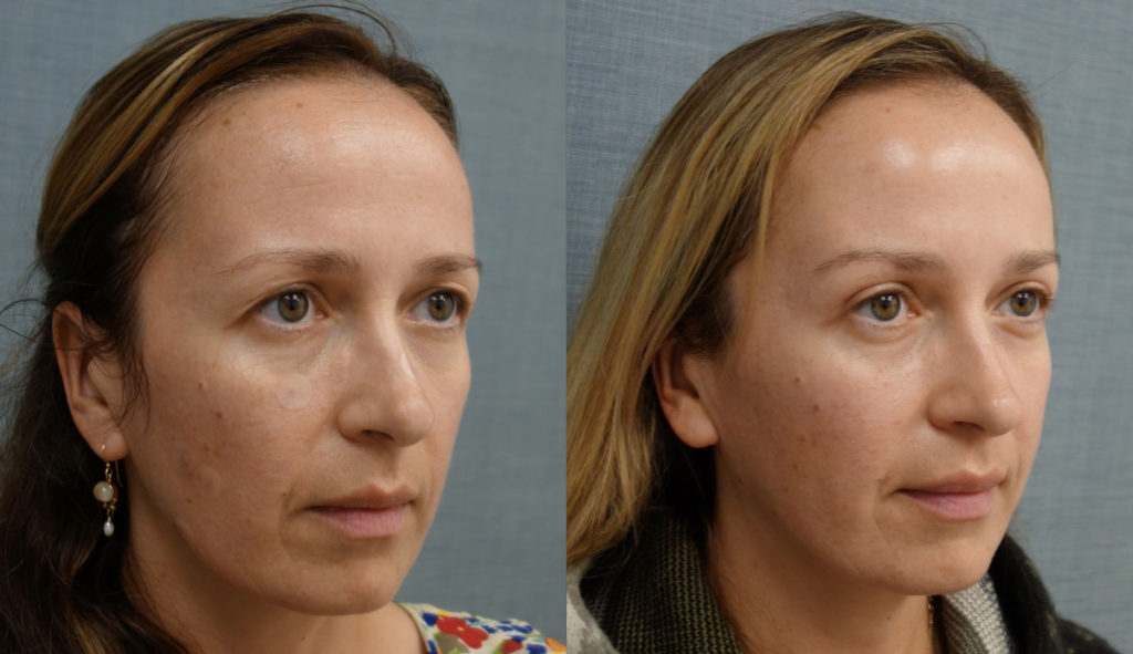 Bilateral Upper Eyelid Blepharoplasty Patient 11-B 