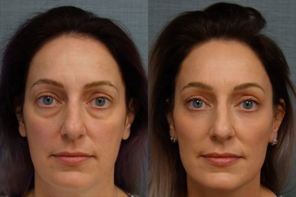 Upper Eyelid Blepharoplasty, Mini Brow Lift, Lower Eyelid Blepharoplasty with Internal Cheek Elevation, Chemical Peel to Lower Eyelids Patient 09-A 