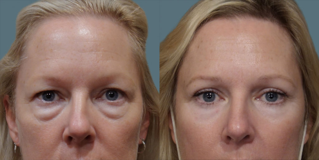 Upper and Lower Eyelid Blepharoplasty Patient 02-A 