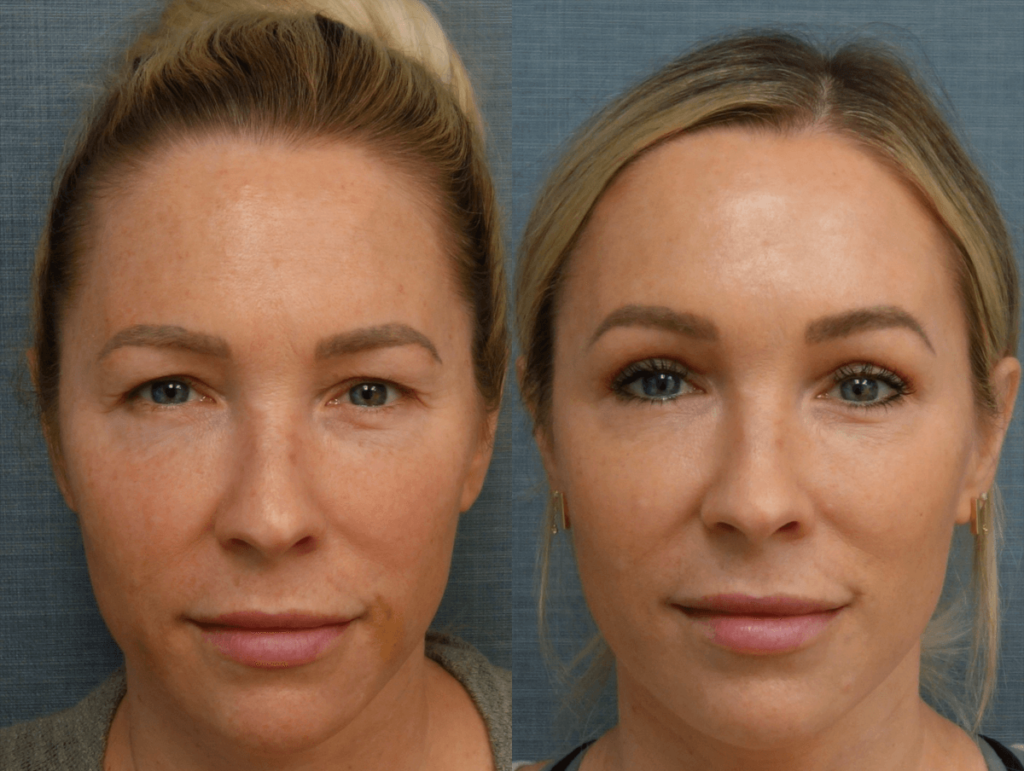 Upper Eyelid Blepharoplasty Patient 08-A 