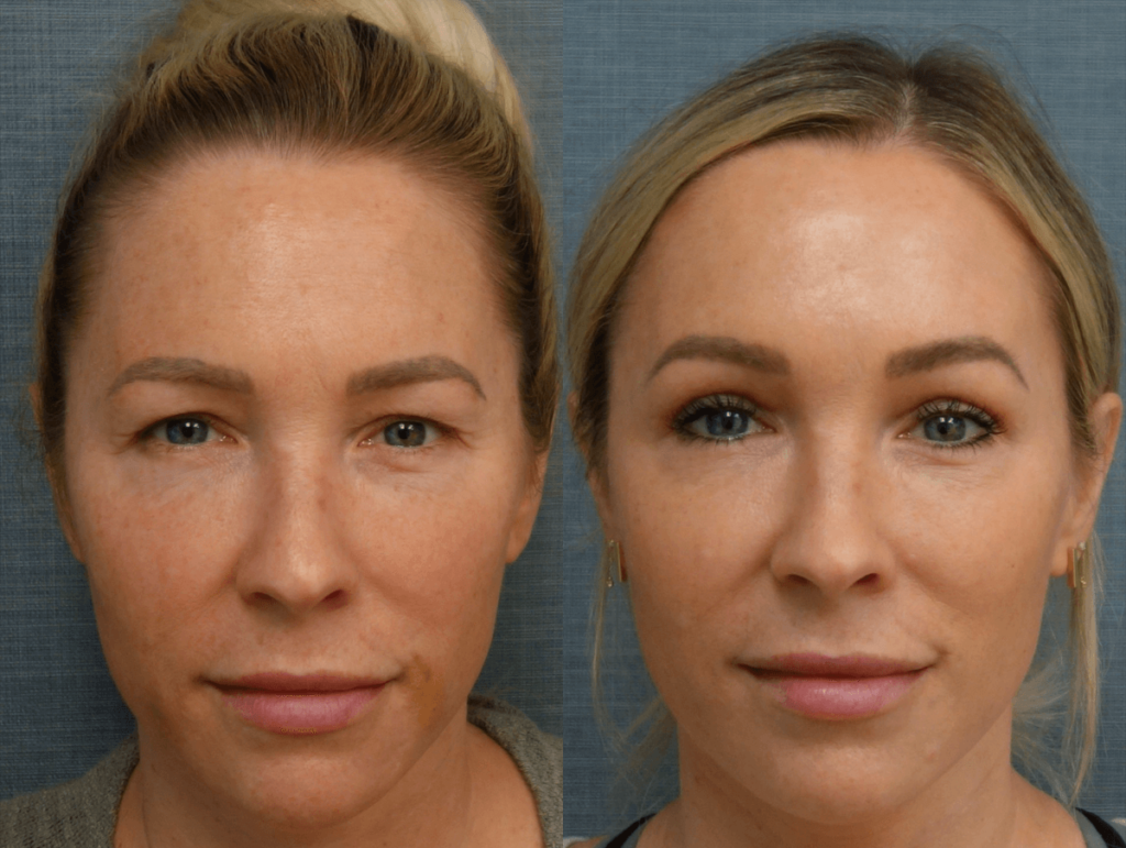 Upper Eyelid Blepharoplasty Patient 48-A 