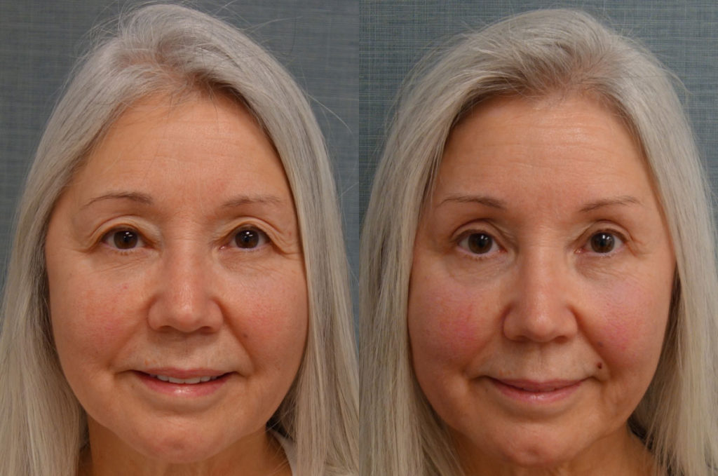 Bilateral Upper Eyelid Blepharoplasty, Mini Brow Lift Patient 55-A 