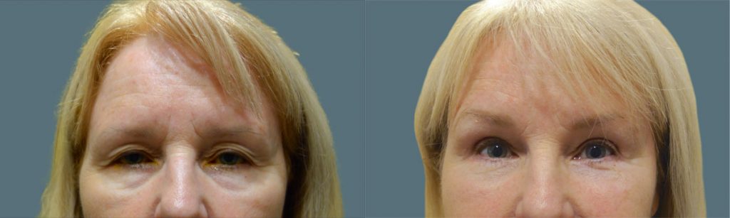 Upper and Lower Eyelid Blepharoplasty and Endoscopic Brow Lift Patient 18-A 