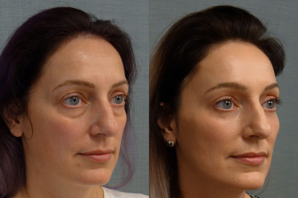 Upper Eyelid Blepharoplasty, Mini Brow Lift, Lower Eyelid Blepharoplasty with Internal Cheek Elevation, Chemical Peel to Lower Eyelids Patient 09-B 