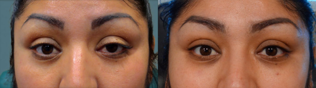 Left Upper Eyelid Internal Ptosis Repair Patient 01 