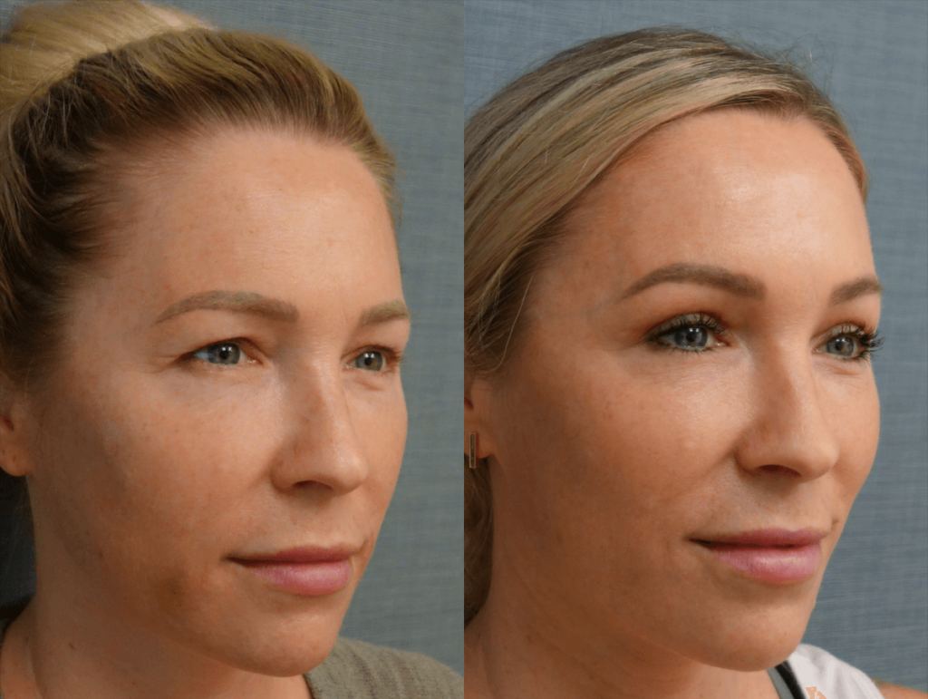 Upper Eyelid Blepharoplasty Patient 08-B 