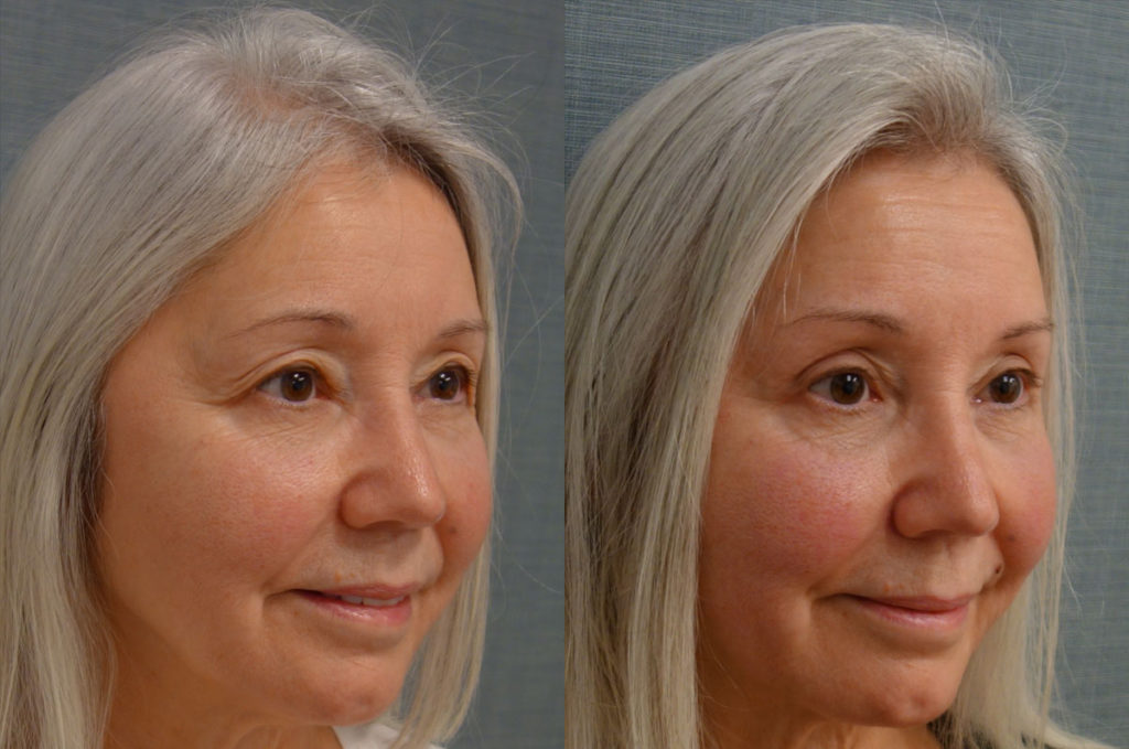 Bilateral Upper Eyelid Blepharoplasty, Mini Brow Lift Patient 55-B 