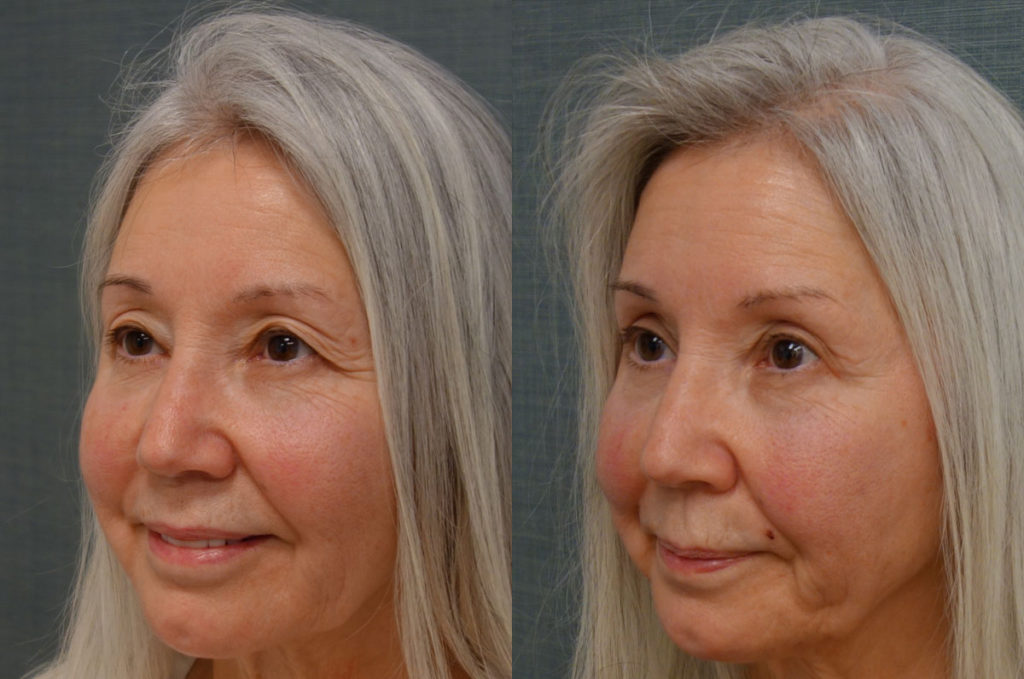 Bilateral Upper Eyelid Blepharoplasty, Mini Brow Lift Patient 55-C 
