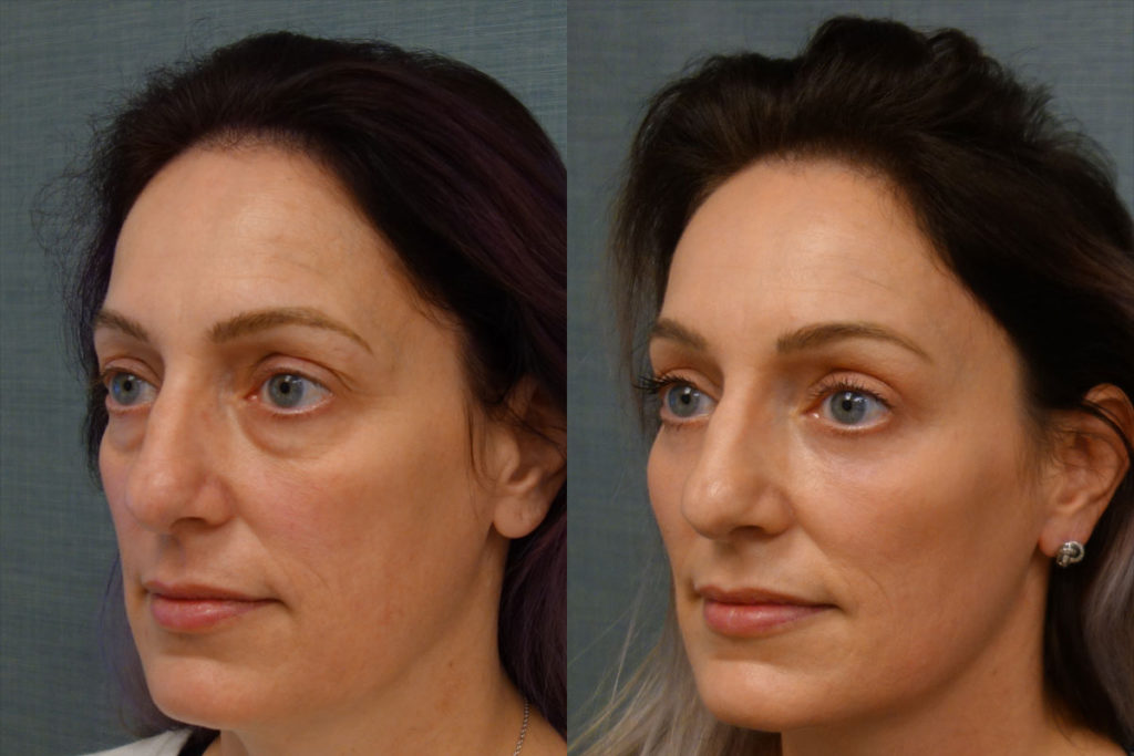 Upper Eyelid Blepharoplasty, Mini Brow Lift, Lower Eyelid Blepharoplasty with Internal Cheek Elevation, Chemical Peel to Lower Eyelids Patient 09-C 