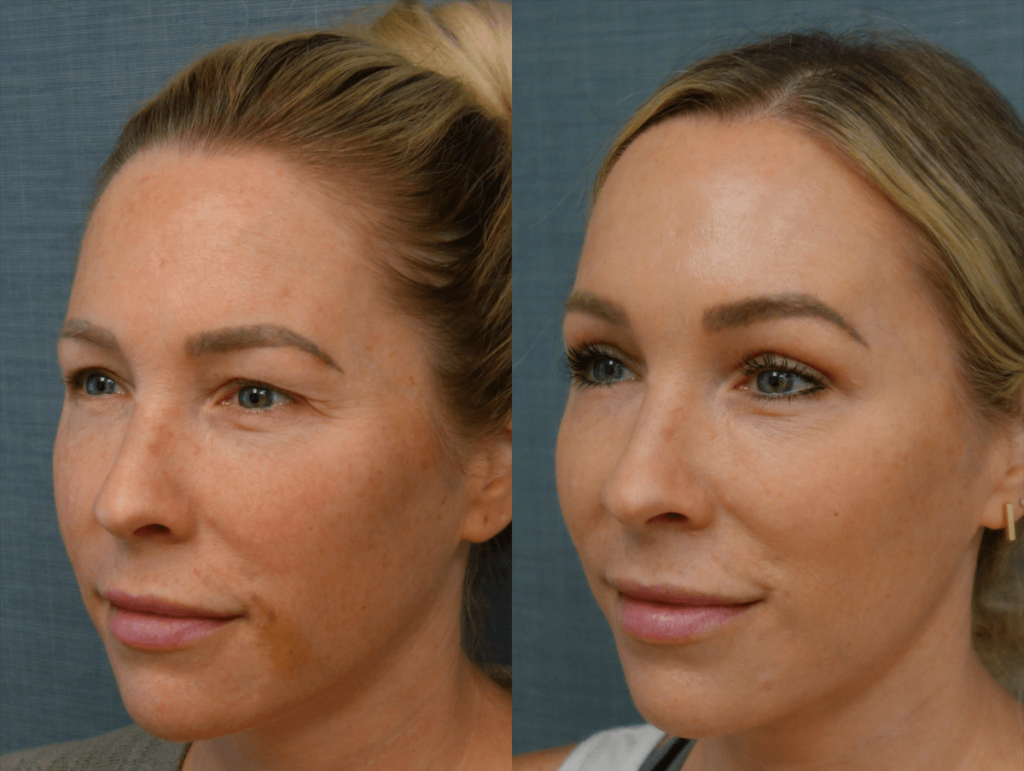 Upper Eyelid Blepharoplasty Patient 08-C 