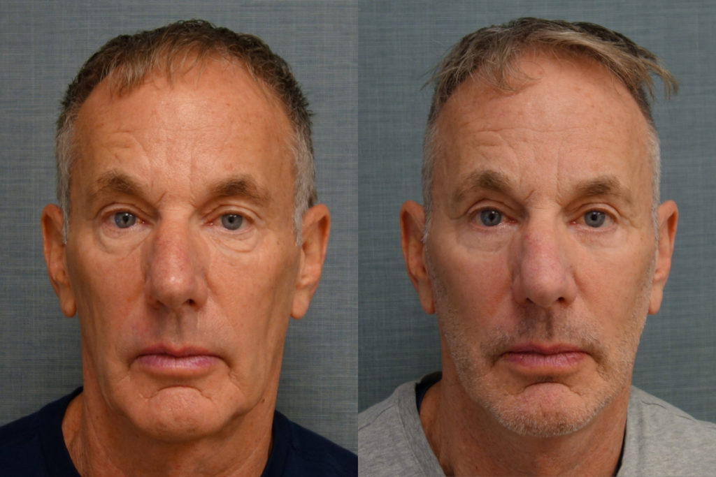Bilateral Upper Eyelid Blepharoplasty, Bilateral Lower Eyelid Blepharoplasty, Bilateral Upper Eyelid Internal Ptosis Repair Patient 21-A Bilateral Upper Eyelid Blepharoplasty, Bilateral Lower Eyelid Blepharoplasty, Bilateral Upper Eyelid Internal Ptosis Repair Patient 21-A
